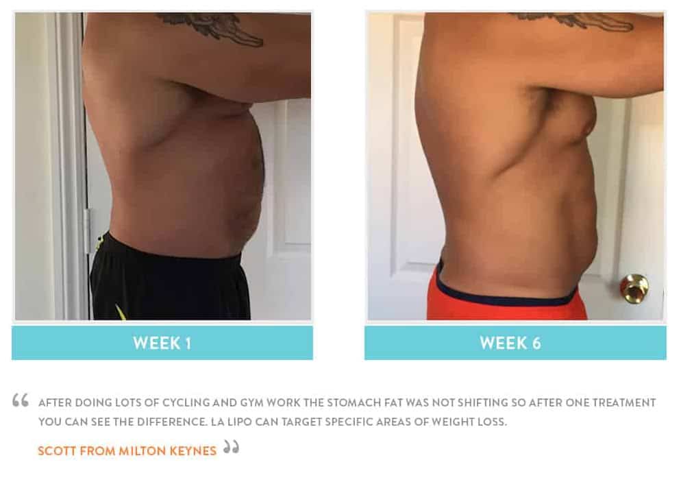 Before & After Stomach Fat Greater London (Hillingdon)