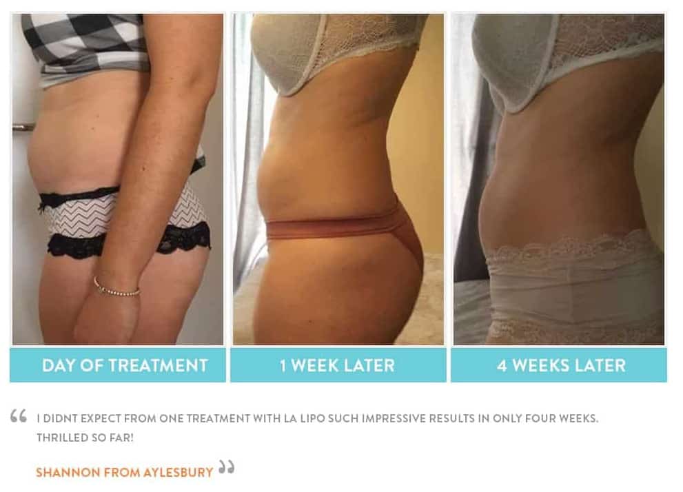 before, Cryolipolysis Greater London (Hillingdon)