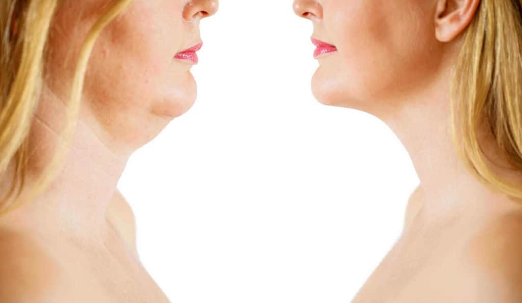 Double Chin treatment Greater London (Hillingdon) before and after results