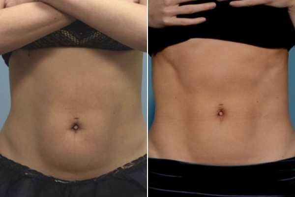 body sculpting FAQs Greater London (Hillingdon)