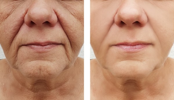 Learn more about Morpheus8 Treatment Greater London (Hillingdon) today!