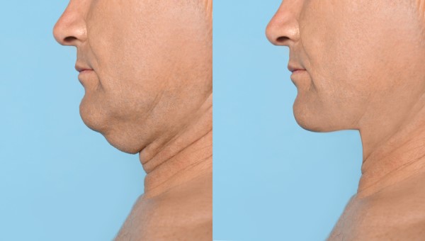 Which Non-Surgical Treatments Work Best for Jowls and Loose Skin Greater London (Hillingdon)?