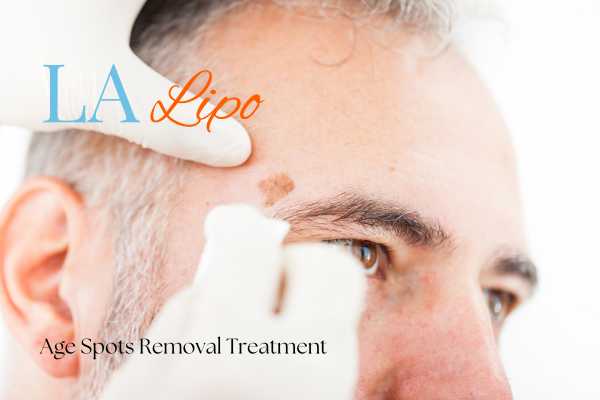 age spots