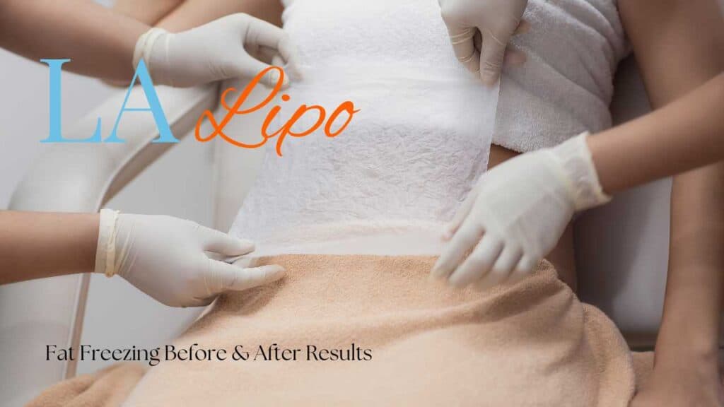before; cryolipolysis
