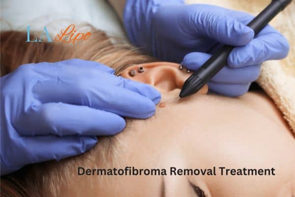 Dermatofibroma Removal Treatment Greater London (Hillingdon)