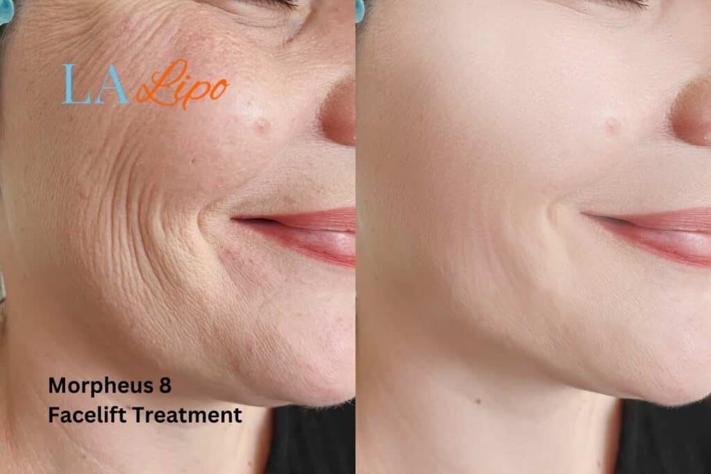 Morpheus8 Treatment Greater London (Hillingdon) for flawless skin! Call us today!