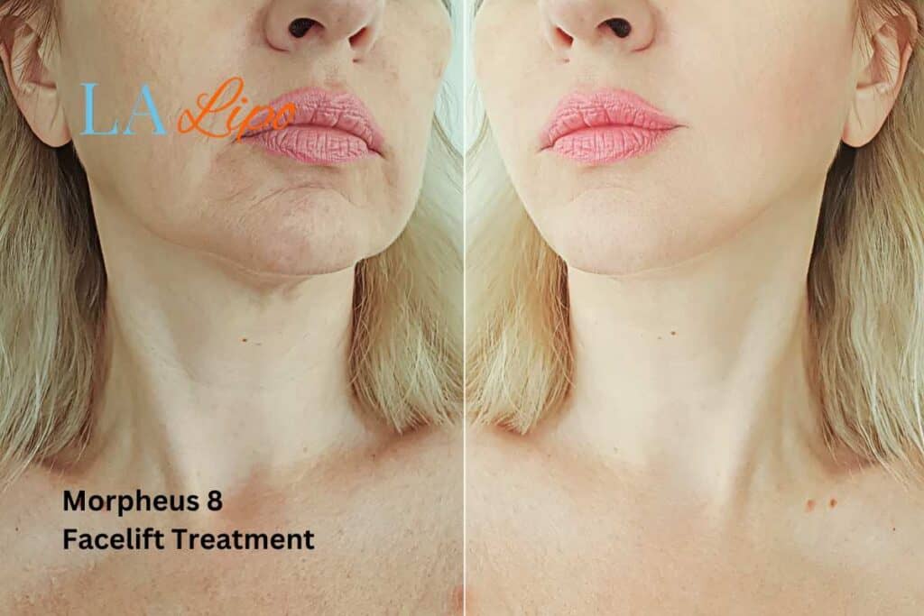 Turn back time with Morpheus8 Treatment Greater London (Hillingdon)