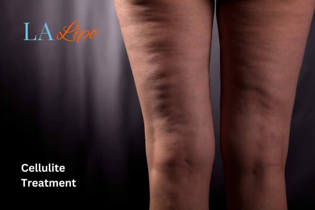 cellulite
