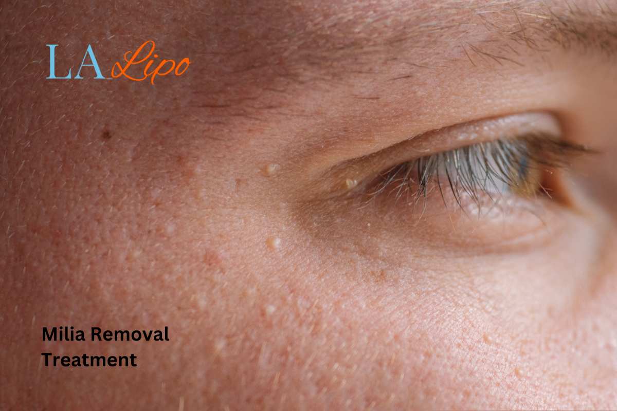 Cryopen Milia Removal: Is It the Easiest and Safest Option Greater London (Hillingdon)?