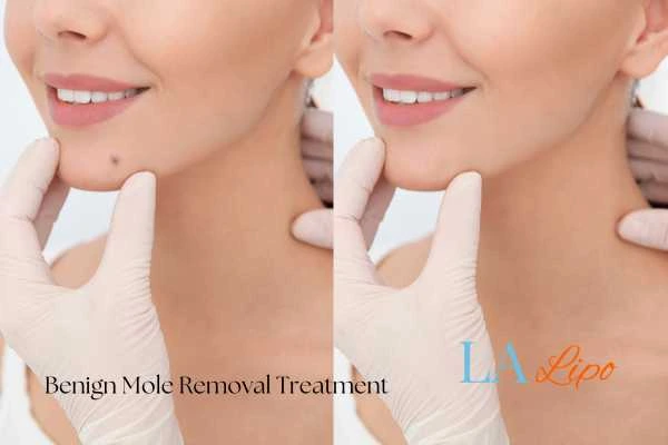woman's before and after mole removal Greater London (Hillingdon) results
