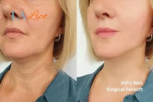 hi-fu for wrinkles Greater London (Hillingdon) before and after results