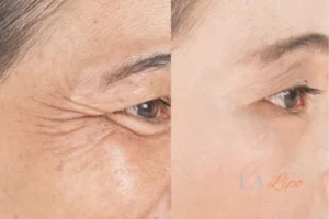 Before and after results of woman - HI-fu wrinkles reduction treatment Greater London (Hillingdon)