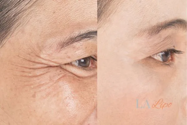 Before and after results of woman - HI-fu wrinkles reduction treatment Greater London (Hillingdon)