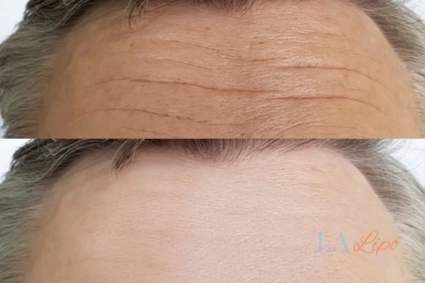 results of HIFU Greater London (Hillingdon) on mans forehead to help reduce lines and wrinkles
