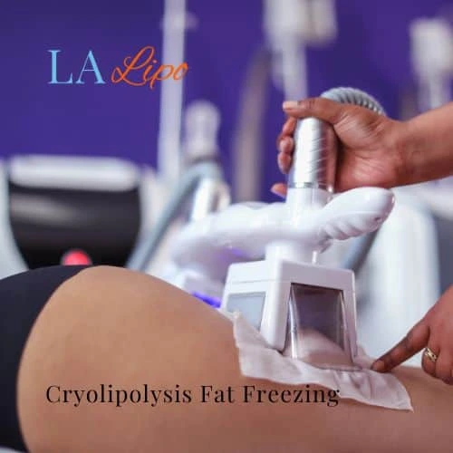 fat freezing - Cryolipolysis Greater London (Hillingdon)
