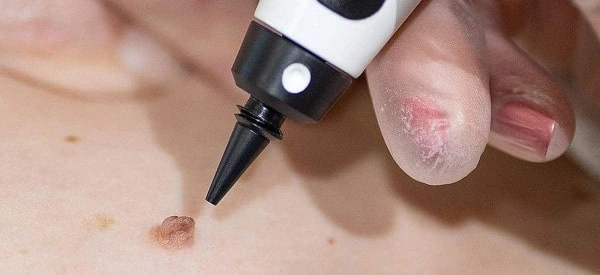 skin tag removal using cryopen Greater London (Hillingdon)