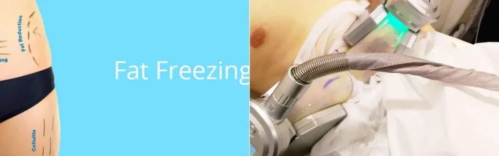 Fat freezing Greater London (Hillingdon) on multiple areas of the body