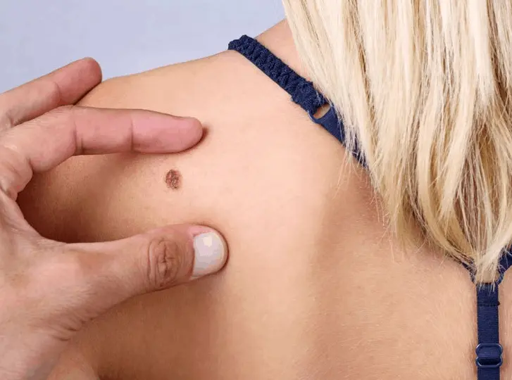 woman having mole removal Greater London (Hillingdon) consultation before treatment.