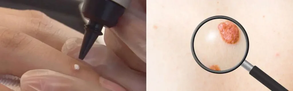 Cryopen for mole removal Greater London (Hillingdon) - speak to our team today!