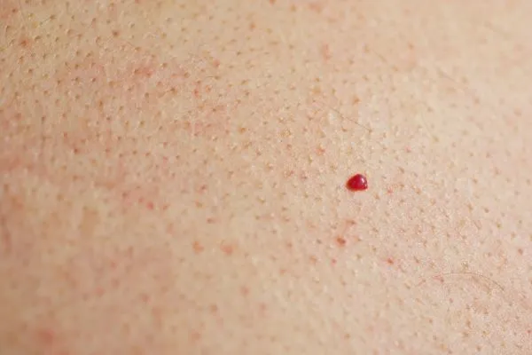 close up of a cherry angioma Greater London (Hillingdon)