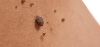 image of a skin tag Greater London (Hillingdon)