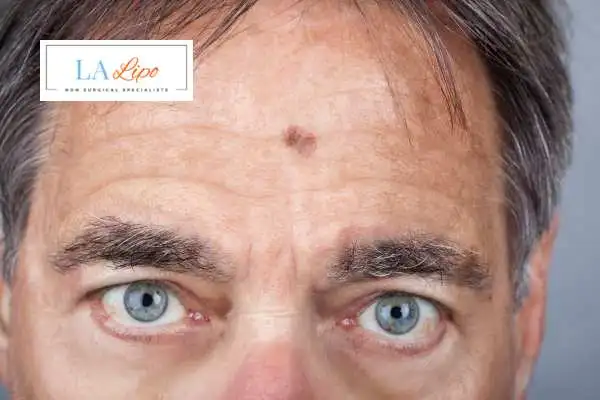 Solar Lentigo Removal Greater London (Hillingdon) image of man with mark on his forehead