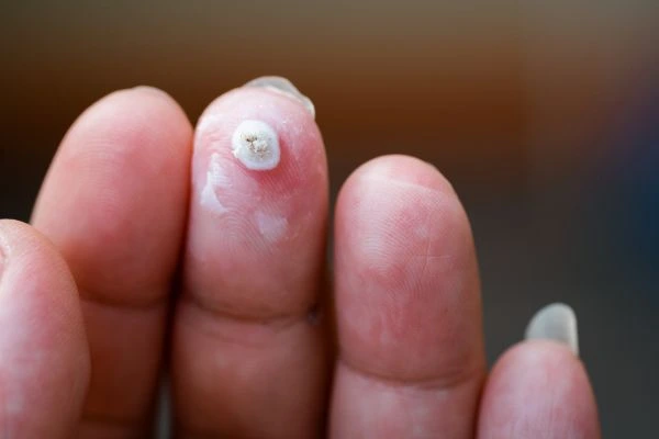 wart on person finger - cryotherapy to treat from LA LIPO Greater London (Hillingdon)