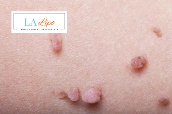 Does cryopen skin tag removal Greater London (Hillingdon) hurt? Find out now call our team today!