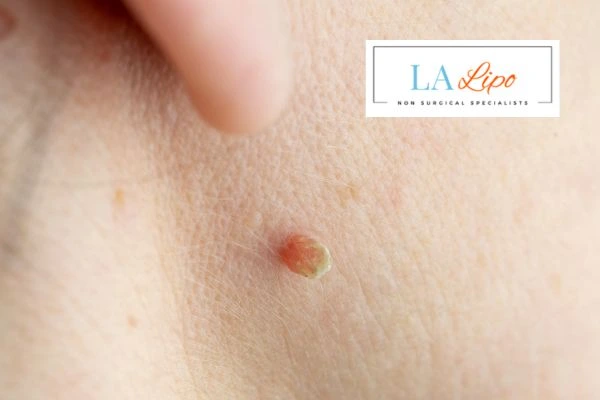 Book skin tag removal Greater London (Hillingdon) today speak to our team now!