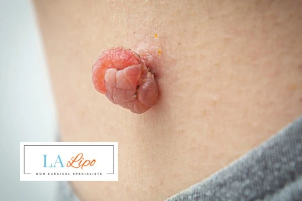 Interested in skin tag removal Greater London (Hillingdon)? Concerned about the pain? Find out more today!