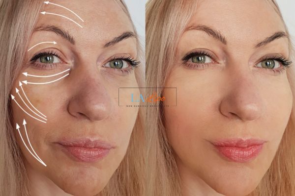 Morpheus 8 results Greater London (Hillingdon) face lift.