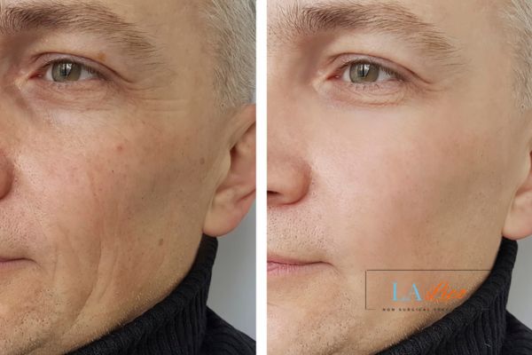 See the amazing results of Morpheus8 Treatment Greater London (Hillingdon)!
