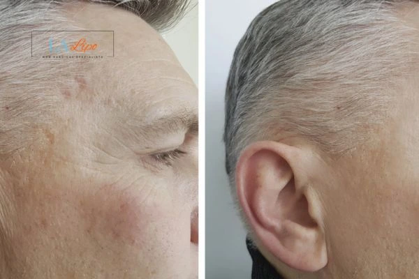Mens Before & After Morpheus 8 Results Greater London (Hillingdon)