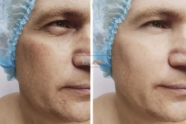 Before and after Morpheus 8 Results Greater London (Hillingdon)