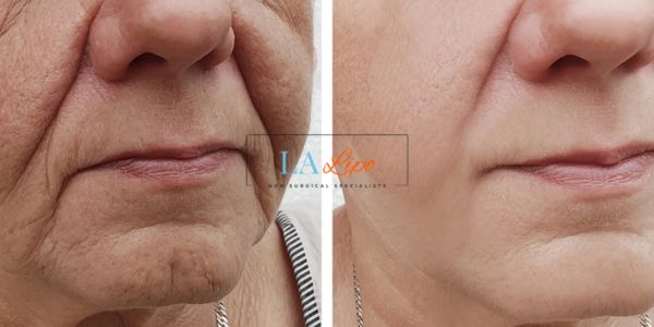 Older lady deeper wrinkle reduction - LA LIPO Morpheus 8 Results Greater London (Hillingdon)
