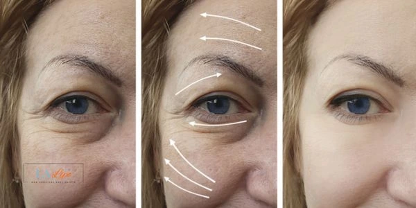 Amazing eye lift Morpheus 8 results Greater London (Hillingdon)