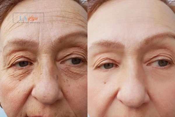 The powerful benefits of Morpheus8 Treatment Greater London (Hillingdon) - Call Our team today!
