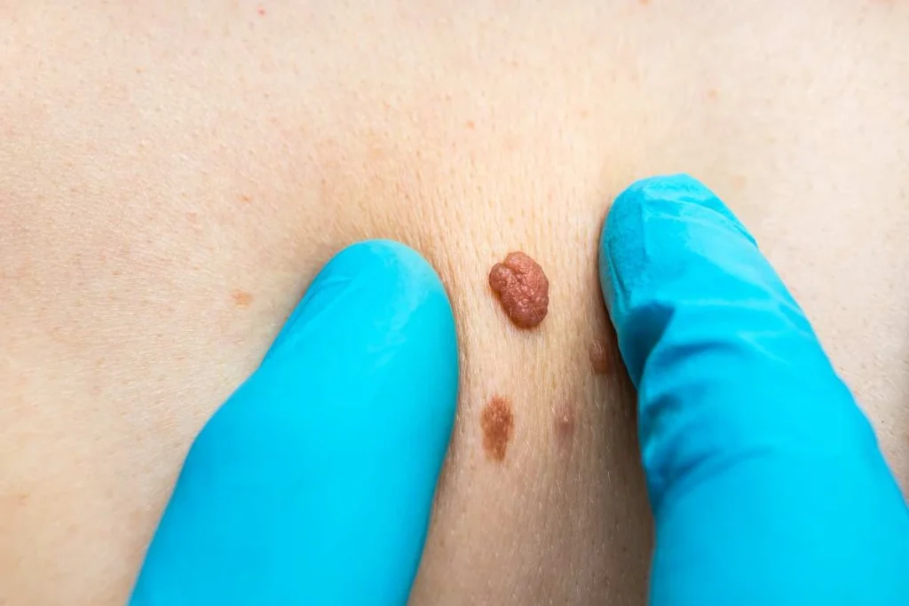LA LIPO Cryopen Lesion Removal Prices Greater London (Hillingdon)