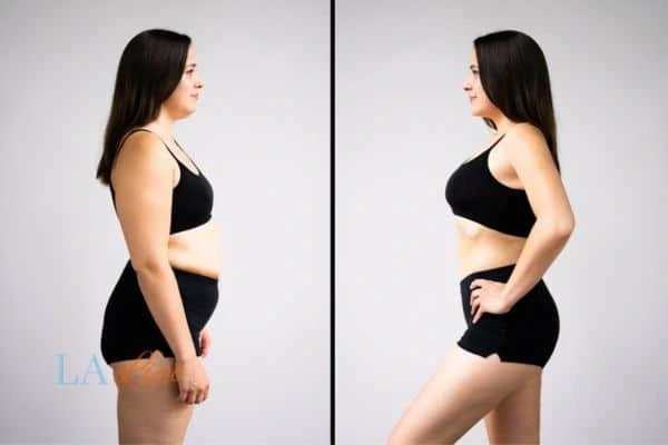Picture of womans before and after using LA-EMS body sculpting to improve her core strength Greater London (Hillingdon)