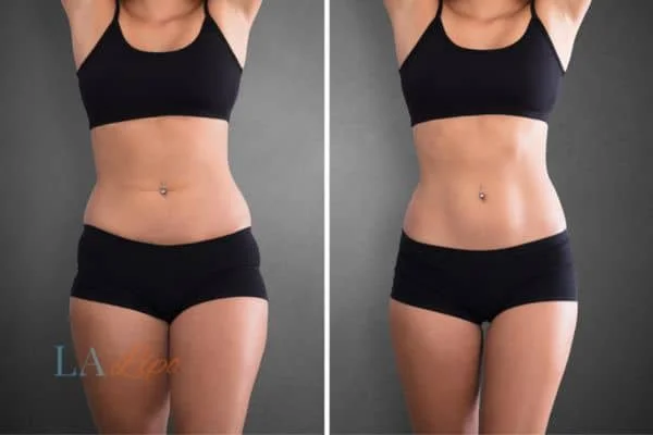 before and after results of non-surgical treatment to help a woman's body image and mental health Greater London (Hillingdon)