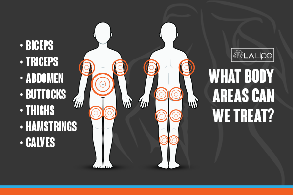 Diagram to show areas you can have LA-EMS Body Sculpting Treatment Greater London (Hillingdon)