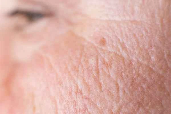 close up picture of a woman's face showing an age spot Greater London (Hillingdon)