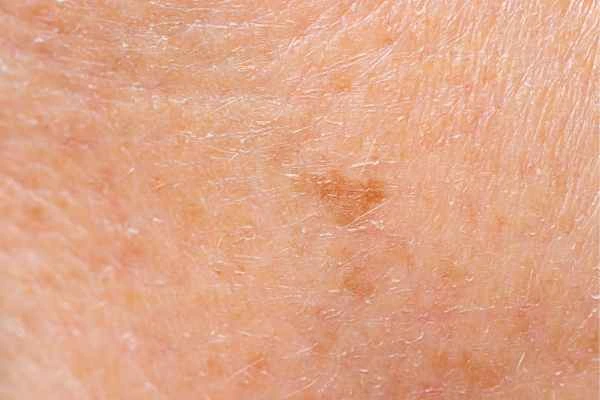 close up picture of age spots Greater London (Hillingdon)