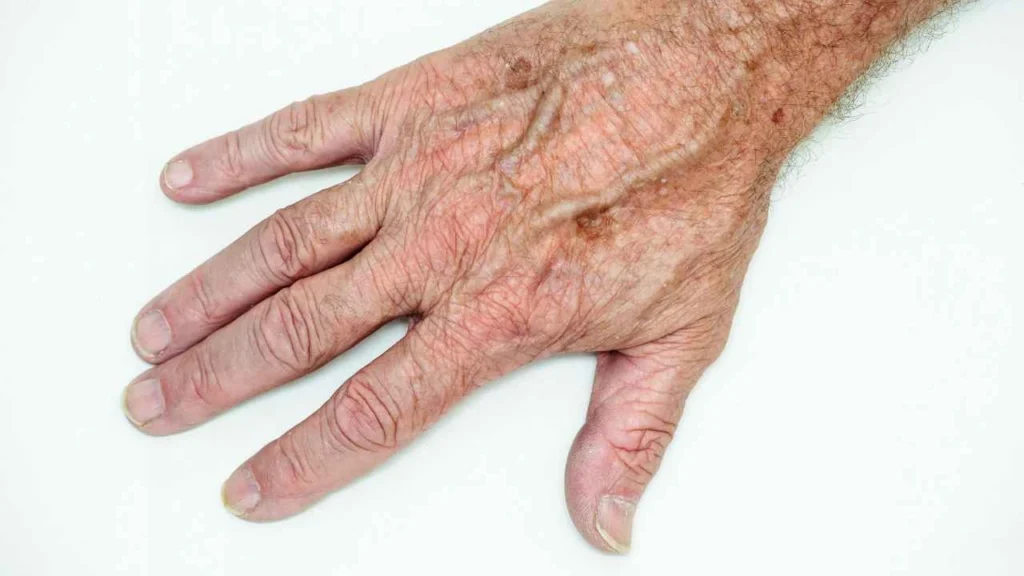 Male hand showing age spot Greater London (Hillingdon)