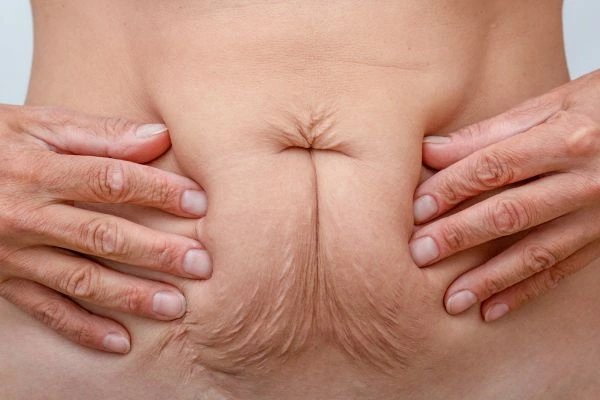 Should I Combine Diastasis Recti Treatment with Body Contouring for Better Results Greater London (Hillingdon)?